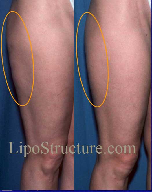 Outer thigh liposuction deformities