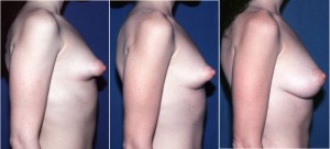 Tuberous Breast corrected with fat grafting profile view