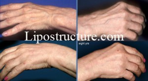 hand rejuvenation