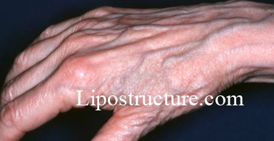 hand rejuvenation