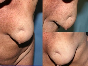 Breast Reconstruction Following Fat Transfer