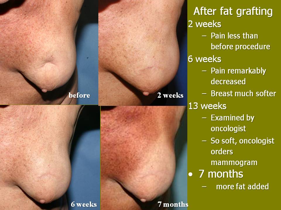 A, The patient before the first session of fat grafting, after 2