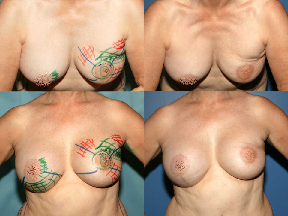 Patient Kathy with pixilated nipples