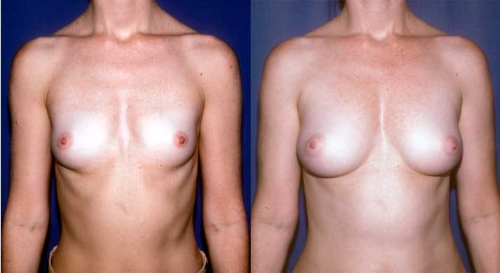 Before (left) and seven years after (right) one fat placement of 190 ml on the right side and 245 ml on the left. Note the filling of the "cleavage" area and the very natural appearance (and feel) of the breast