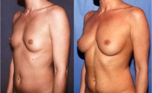 Before (left) and 8 years 9 months after one fat grafting procedure of 332 ml to the right and 297 ml to the left. Patient had 10 pound weight loss between procedures