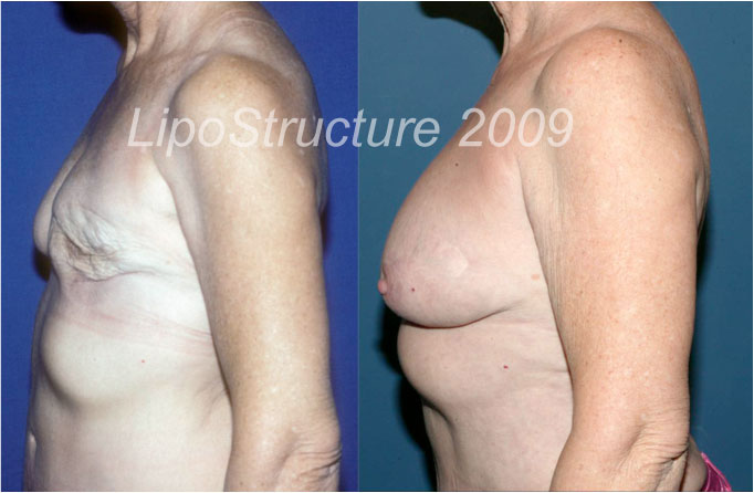 6 1/2 years after the last of 2 fat grafting sessions. Her breasts now feel and look completely natural after only two sessions of fat grafting. In addition, her body has improved from the removal of fat from her abdomen and waist.