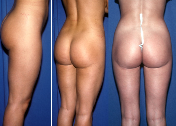 Buttock crease created by suctioning of the buttock/thigh juncture. This can make a leg look shorter and a buttock look deformed. 