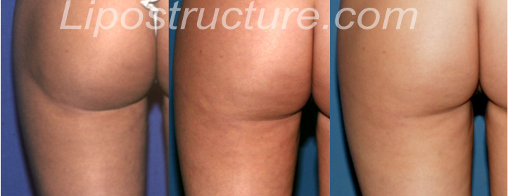 The left buttock crease correction before (left), one year after (middle) and four years after (right) one fat injection to the buttock crease extending out over to the left outer thigh. Note the remarkable improvement in texture and color of the skin over time. That is a consistent finding with fat grafting close to the skin. 