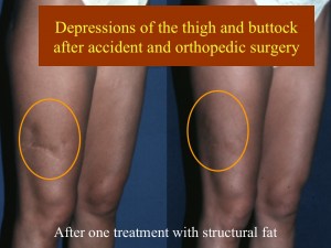 Coleman Fat Grafting used to correct depressed scar on thigh