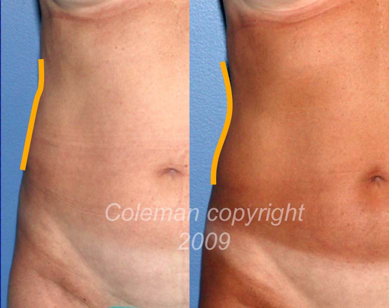 Lines help to better distinguish the change in contour. This patient wrote at one year after the treatments: “Dr. Coleman, I wanted to tell you that the procedure that you performed on me really works - I can not believe that all of my clothes are big on me - and Ihave not be dieting. This is very exciting, when are you doing the "pouch"? Thanks again,”