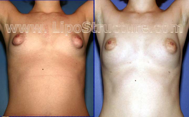 Patient's primary goal was increasing the size of her lower breasts