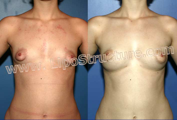Breast Augmentation with only one session of Structural Fat Grafting