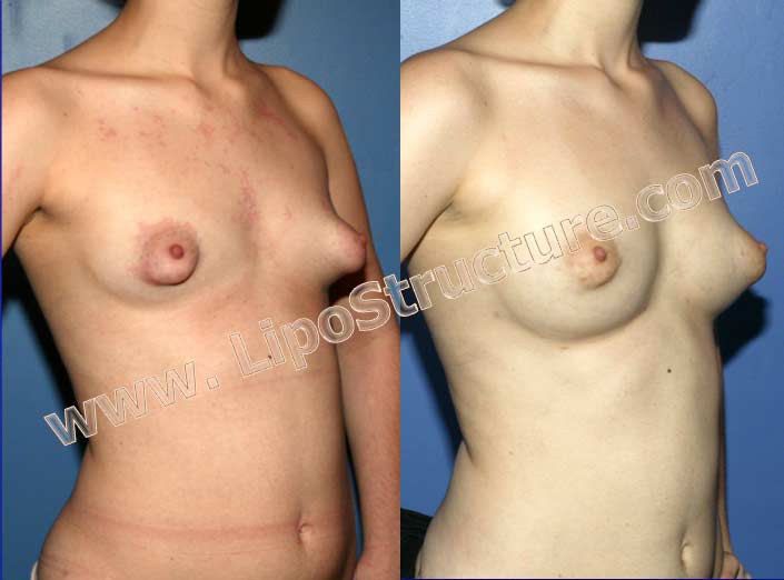 Before (left) and after (right) Dr. Sydney Coleman placed about 200 ml of fat into each breast