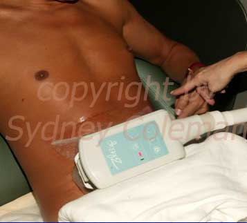 Zeltiq cooling device applied to abdomen of above patient