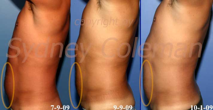 Zeltiq Cooling Procedure 2 months (middle) & 3 months after application to lower abdomen
