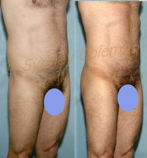 Male buttock enhancement front oblique view