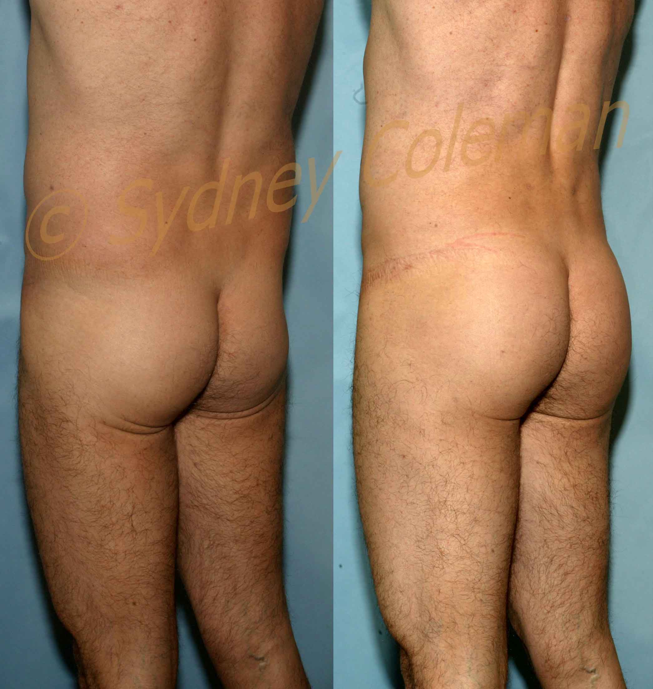 Male Buttock Enlargement posterior oblique view