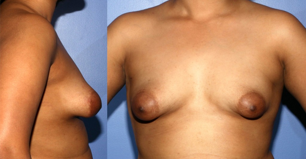 Tubular Breast Correction