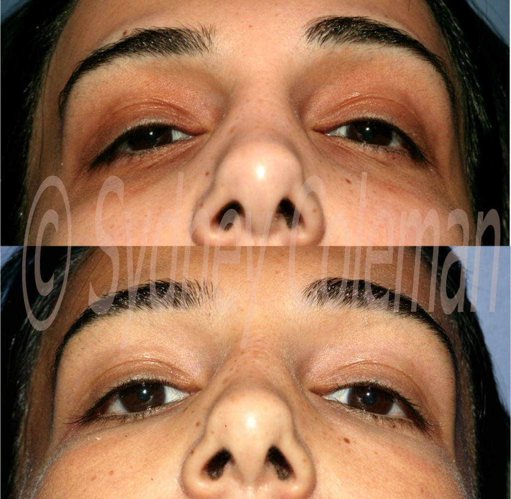 Dark Circles around eyes corrected with structure fat grafts