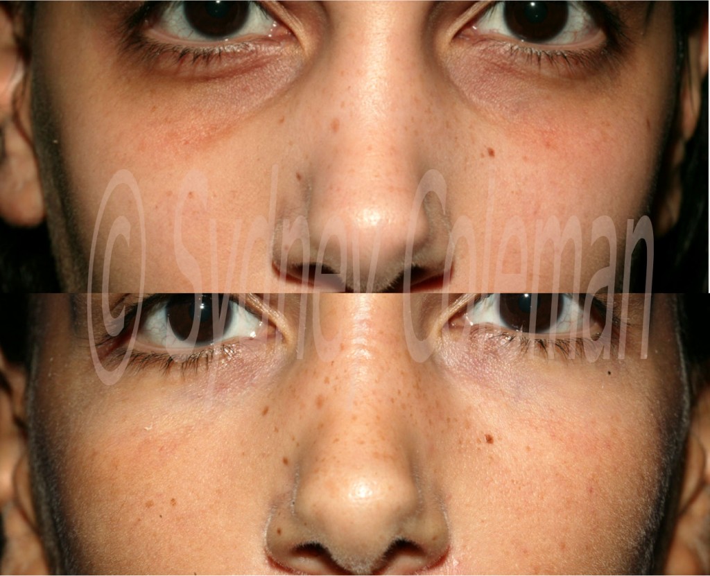 Dark circles around eyes treated with your body's own fat
