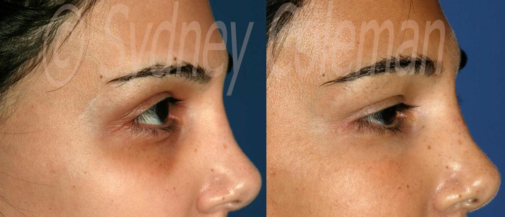 Dark Rings of Eyelids Lightened with Structural Fat Grafts