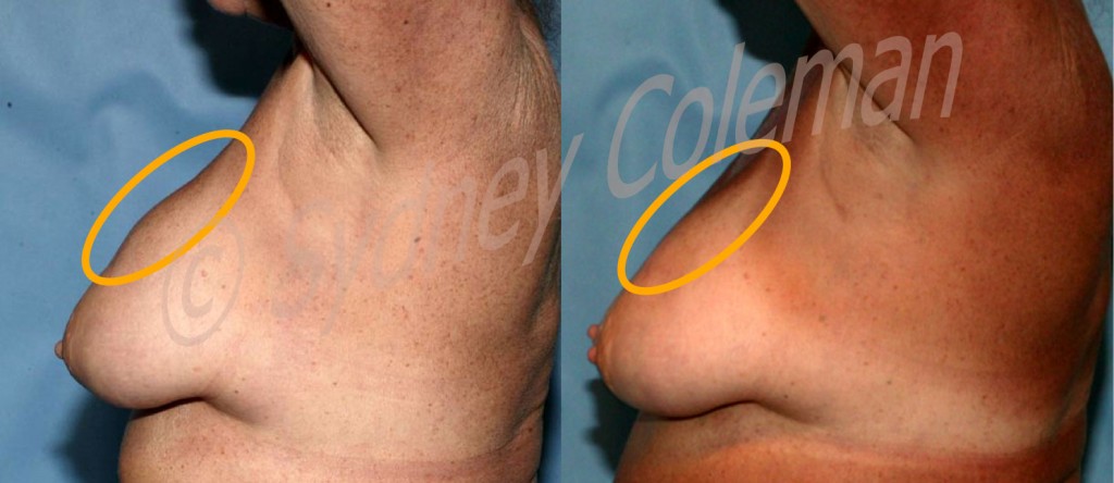 Tuberous Breast Correction Using Coleman Fat Grafting