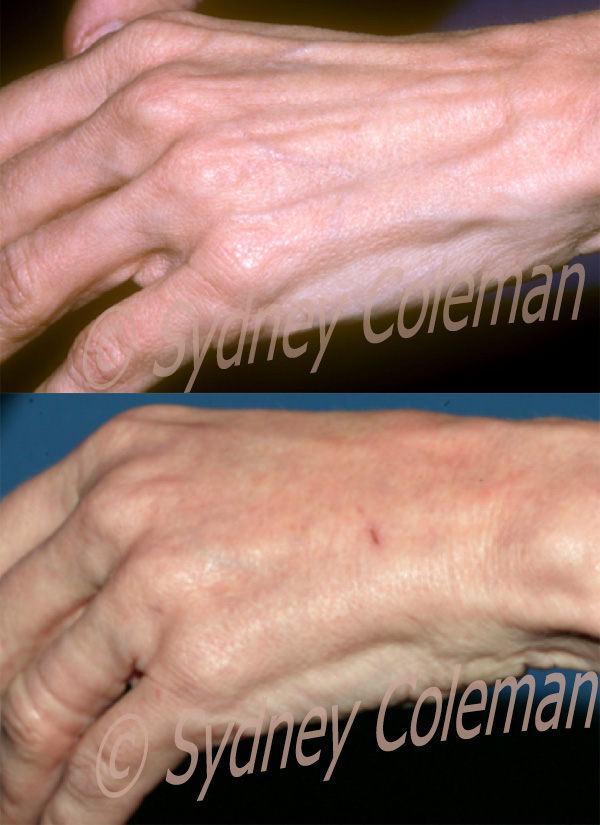 Hand Rejuvenation Closeup