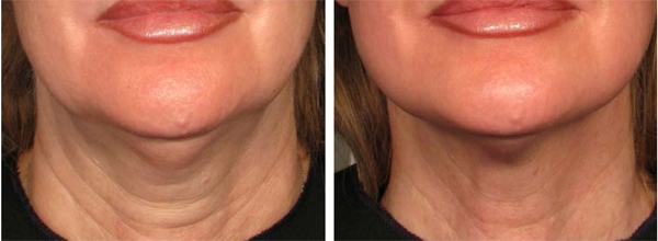 3 months after one Ultherapy treatment to the Neck Photo courtesy of Ulthera