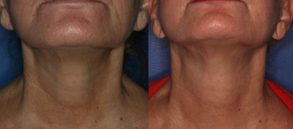 One year after one Coleman fat grafting. Ultherapy would have improved her result.