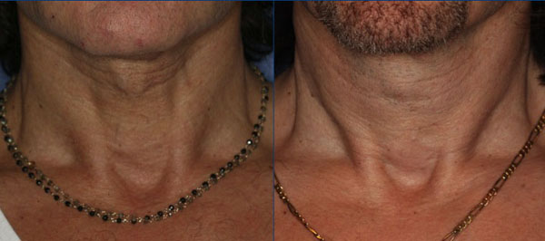 3 years after one Coleman fat grafting to the Neck. Ultherapy has not yet been performed on this patient
