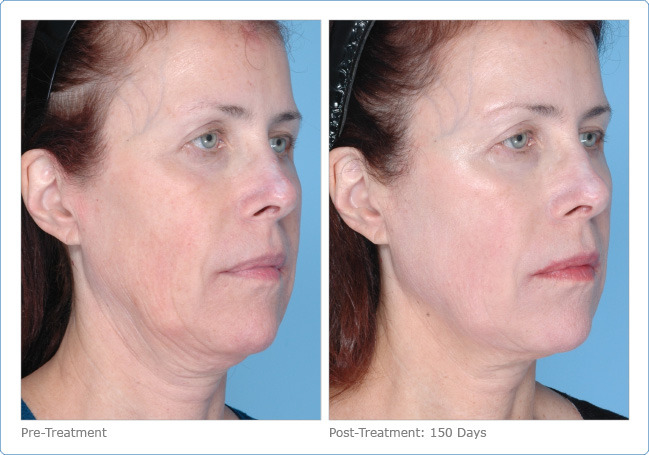 Before (left) and 150 days after (right) Ultherapy treatment (courtesy of Ulthera)