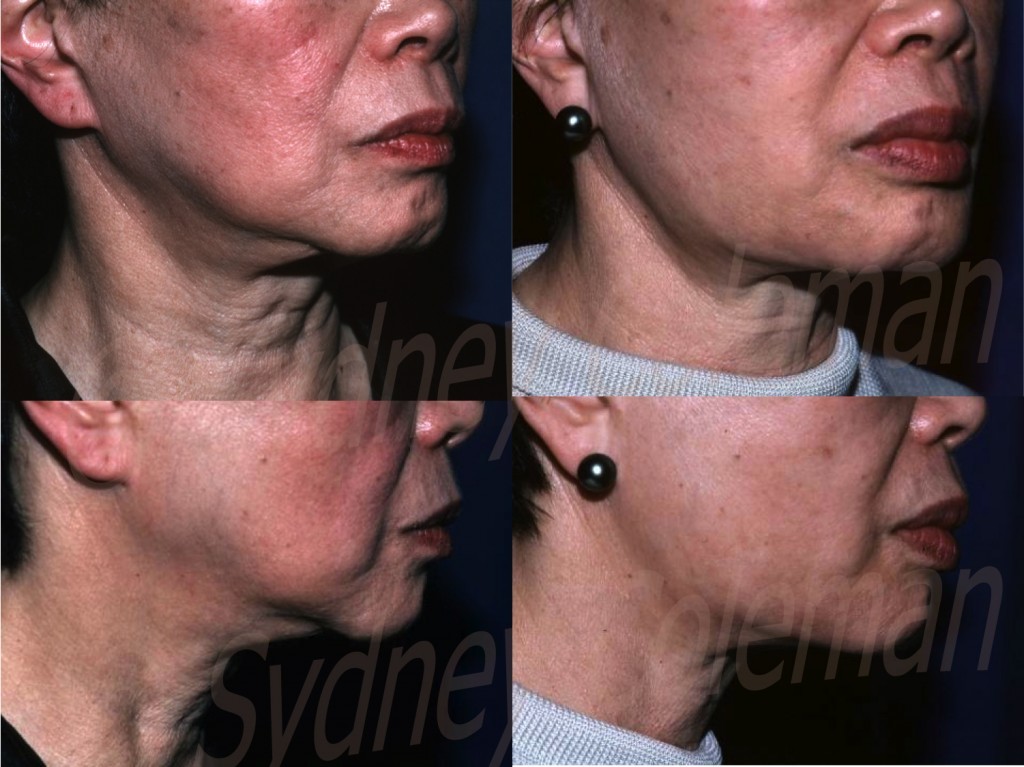 The ability of fat grafting to restore a normal jaw line after aging and facelift is demonstrated in this one year follow-up (right). Note the straightening of the jaw line by placing fat both in front of and behind the jowls