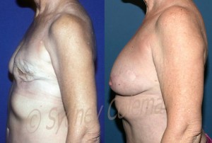 6 years and 5 months after the last of two fat graftings procedures to the breast after removal of breast implants