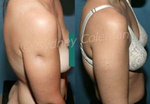 This 30 year old woman presented a year after a steroid injection (to treat allergies) into her arm. A discrete, deep hole had developed and remained on her arm (left). After fat injections to her defect, she had not only a normal contour, but also the skin of the injected area lightened from a grey blue to a healthy pink normal color. She returned at one year (right) pleased with the correction.