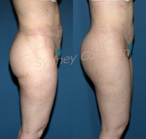 Before (left) and eight months after (right) correction of liposuction deformity of the buttocks, buttock creases, hips and abdomen. Note apparent lifting of the buttock by placement of support into the surrounding areas. She also had a remarkable improvement in the quality of her skin.