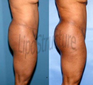 7 months after one fat grafting to the buttock with removal from the back and abdomen. 