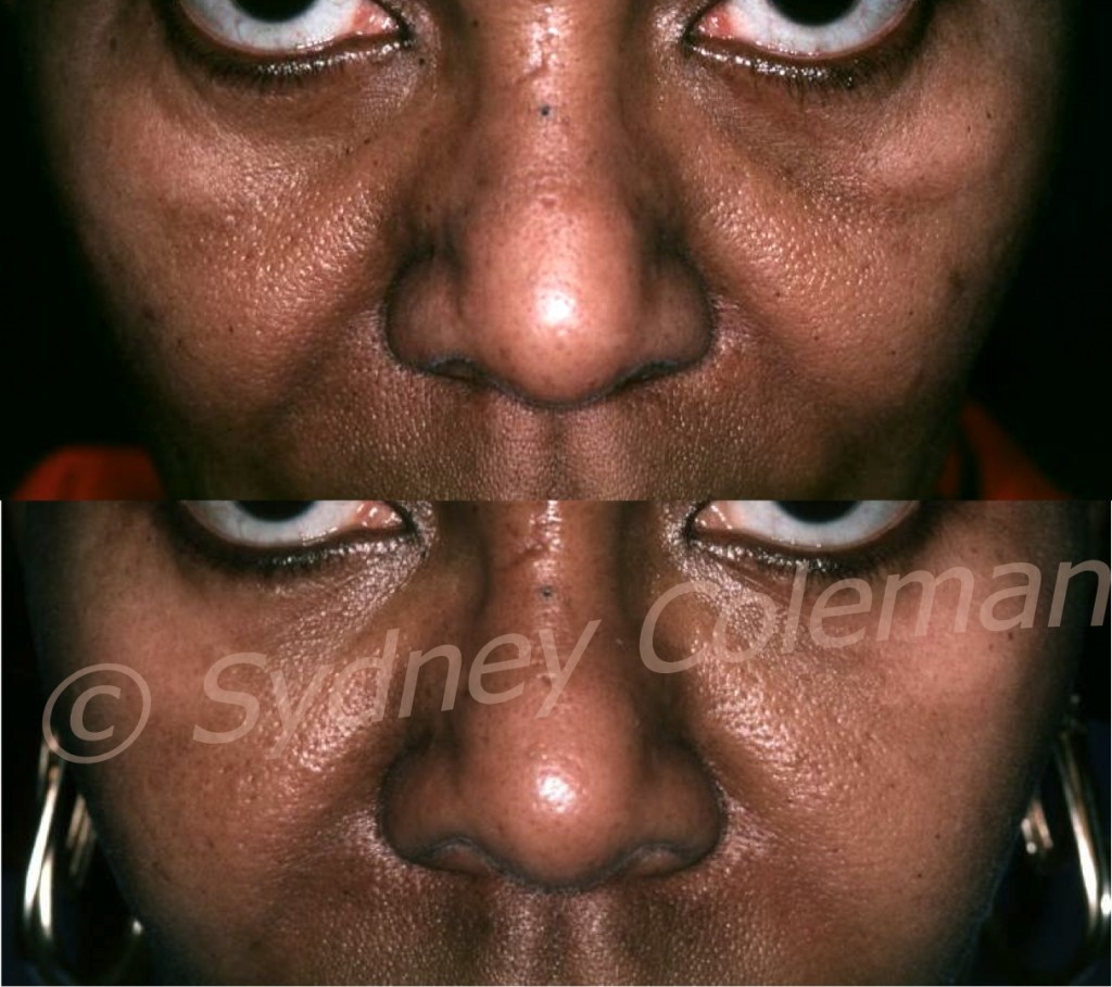 Patient before (above) with deep tear troughs, dark pigmentation and deep pores after a lower eyelid blepharoplasty. 14months after one fat grafting, her lower eyelids are lightened with even pigmentation; smoother skin and remarkably smaller pores.
