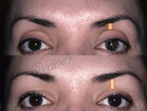 Before and 3years after placement of fat into her upper eyelids and temples. While softening the hollow upper eyelids, filling the area makes the eyebrow look higher. Placement of fullness into the temple makes her outer eyebrows more visible. The acne scarring has also improved.16 months after the addition of a subtle amount of fat grafts to the left upper eyelid. Filling of the area below the eyebrow tightens the loose wrinkled upper eyelid skin. Structural fullness into the temple and outer brow raises the outer brow and makes it more visible from the front view. 